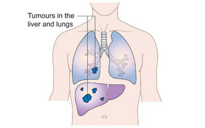 Ung thư gan di căn sang phổi